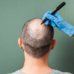 Crown Hair Transplant in Dubai Using FUE Technique Only