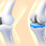 Partial Knee Replacement Surgery in Delhi NCR: A Targeted Solution for Knee Pain