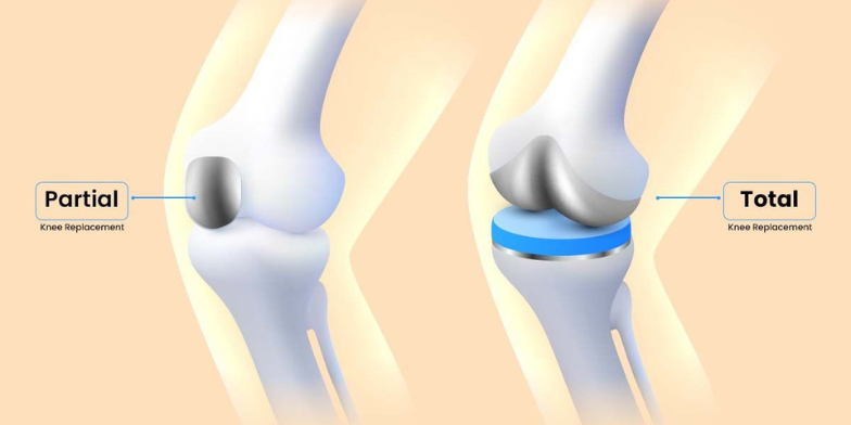 Partial Knee Replacement Surgery in Delhi NCR: A Targeted Solution for Knee Pain