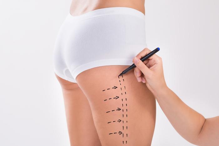 Advanced Vaser Liposuction Techniques by the Best Doctors in Dubai