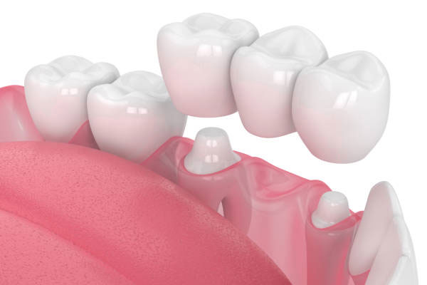 Viha Dental Clinic in Kukatpally | Best Dental Hospital in Kukatpally | Dentist in Kukatpally – Dr. Meenakshi Mudnoor