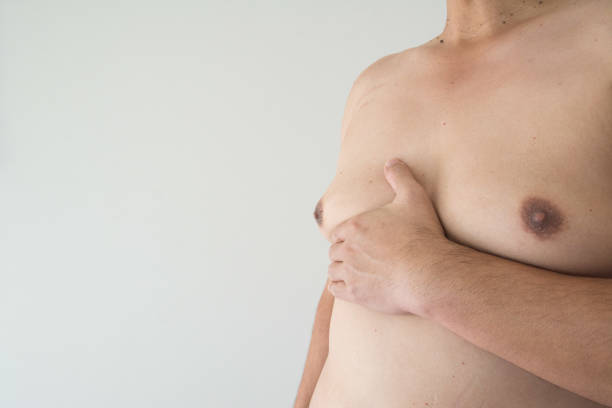Gynaecomastia in Dubai: Scarring Minimization Tips