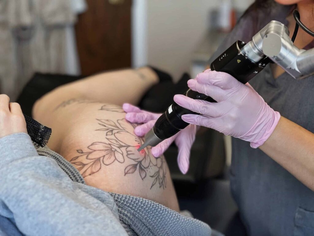 Permanent Tattoo Removal in Dubai: What to Expect from Laser Treatment