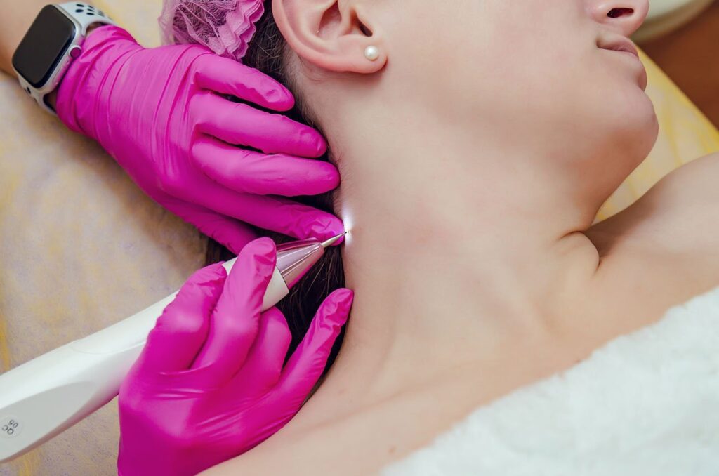Effective Mole & Skin Tag Removal: Best Treatment Options