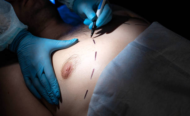 Gynaecomastia Surgery in Dubai: Advanced Skin Tightening