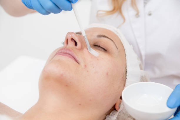Chemical Peels in Dubai for Glowing Skin Transformation