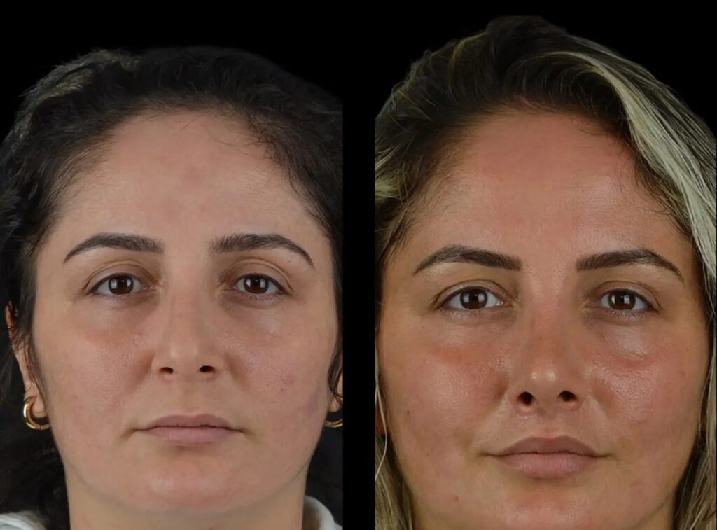 Enhancing Cheekbones with Cheek Fillers Treatment in Dubai