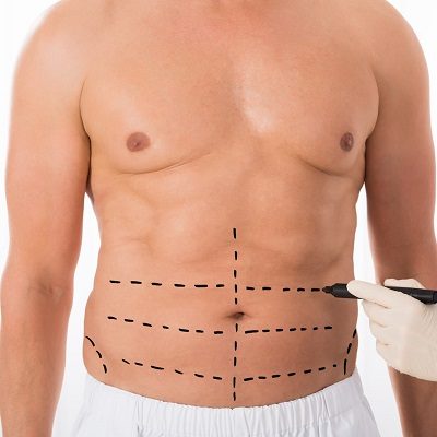 The Complete Guide to Liposuction in Dubai