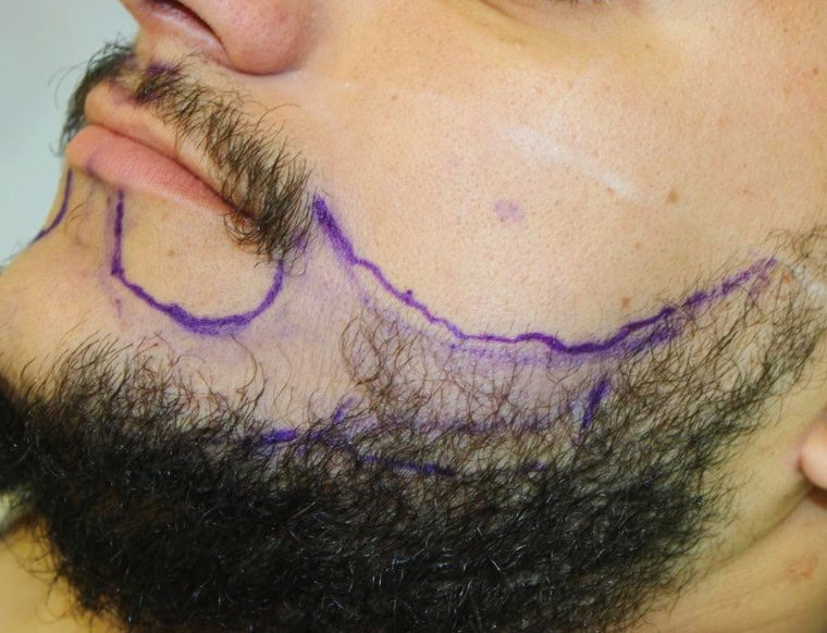 Does a Beard Hair Transplant Leave Scars?