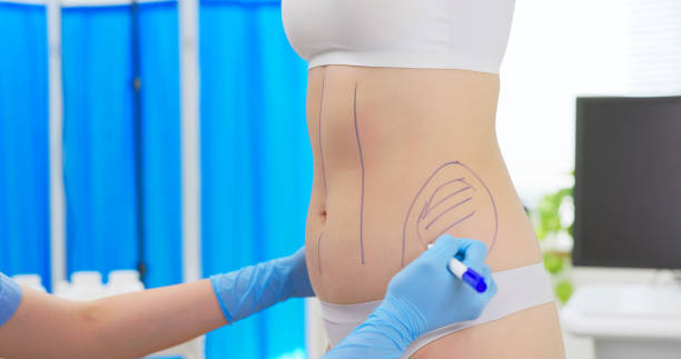 Liposuction Surgery in Dubai: Post-Pregnancy Belly Fat Reduction