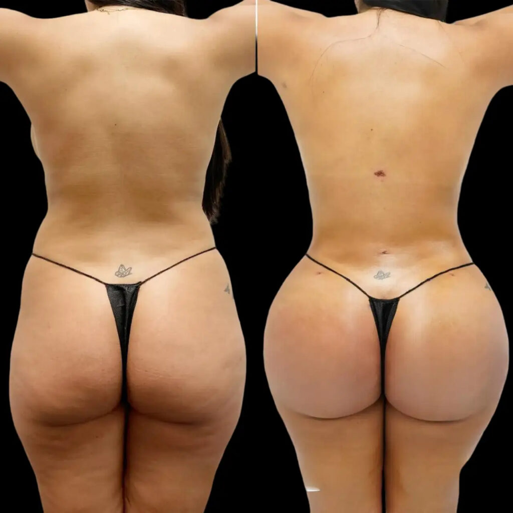 How the Best fat transfer Surgeon in dubai Ensures Long-Lasting Outcomes