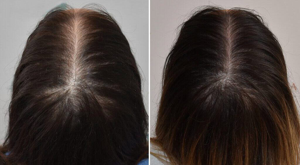 G Cell Treatment for Thinning Crown Area