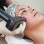 Can Morpheus8 Treatment Revitalize Luminous Complexion Smoothly Safely