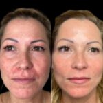 What Skin Concerns Do Best Plastic Surgeons in Dubai Treat with Profhilo?