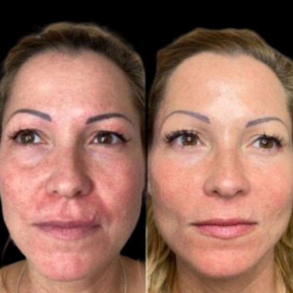 What Skin Concerns Do Best Plastic Surgeons in Dubai Treat with Profhilo?