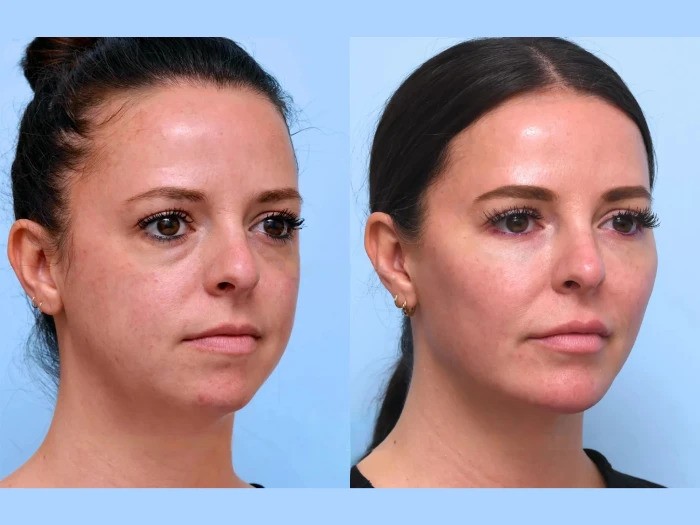 Best Plastic Surgeons in Dubai Delivering Subtle Lift with Natural Thread Lift Results