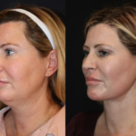 Best Plastic Surgeon in Dubai Explains How Skin Tightening Works