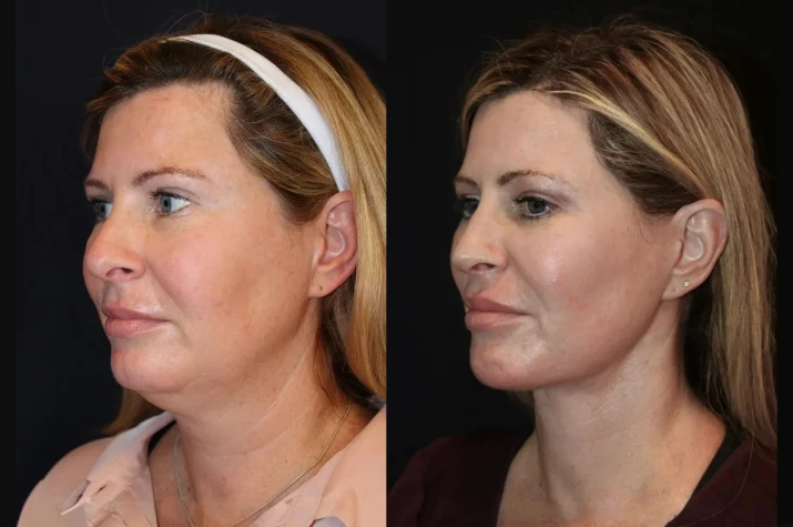 Best Plastic Surgeon in Dubai Explains How Skin Tightening Works