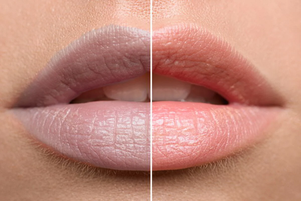 How Laser Treatment for Dark Lips Can Boost Confidence