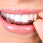 Transform Your Smile with South Pasadena Invisalign: A Clear Path to Confidence