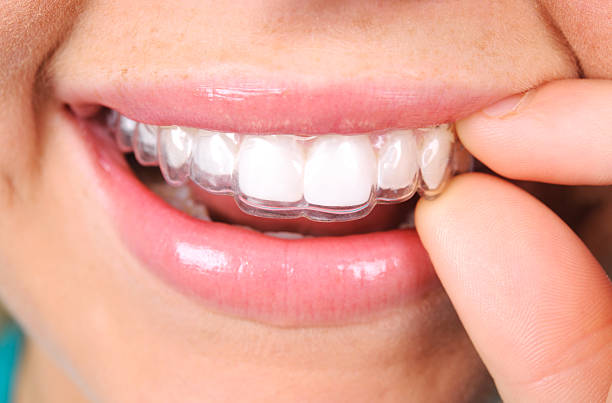 Transform Your Smile with South Pasadena Invisalign: A Clear Path to Confidence