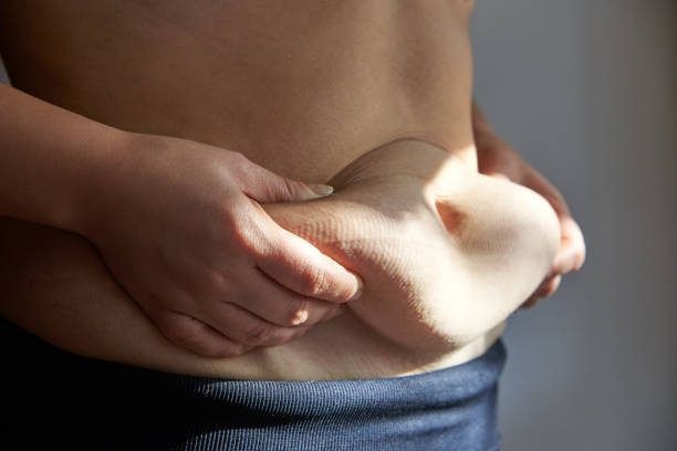 Mini Abdominoplasty Dubai: Quick Fix for Lower Belly Concerns