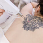 Painless Tattoo Removal in Dubai: Techniques and Tips
