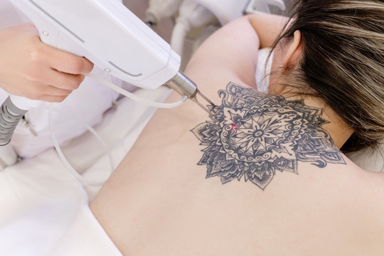 Painless Tattoo Removal in Dubai: Techniques and Tips