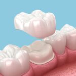 Why Dentists Recommend Tooth Crown Dubai Treatments
