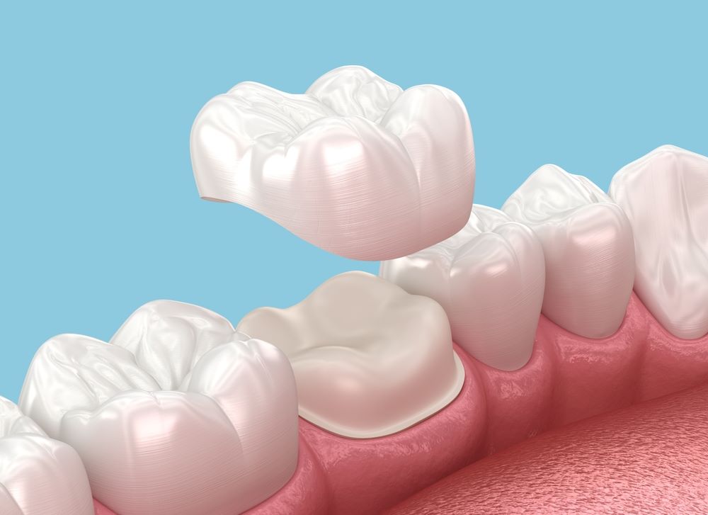 Why Dentists Recommend Tooth Crown Dubai Treatments