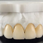 Zirconia Crown Dubai: Durable and Natural-Looking Tooth Crown