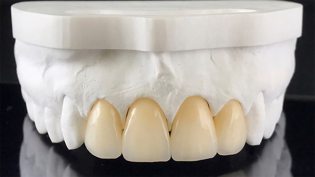Zirconia Crown Dubai: Durable and Natural-Looking Tooth Crown