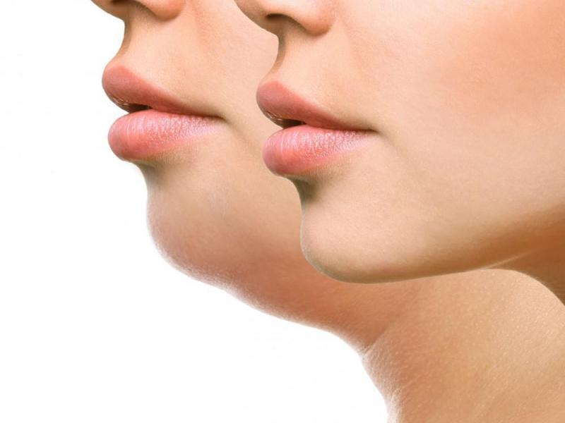 Double Chin Liposuction: Key Advantages You Should Know