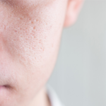 Large Pores Treatment Cost: Budgeting for Clearer Skin