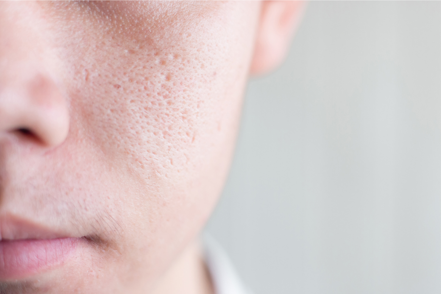Large Pores Treatment Cost: Budgeting for Clearer Skin