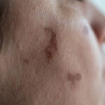 Birthmark Removal in Dubai: 2026 Guide to Tech & Results