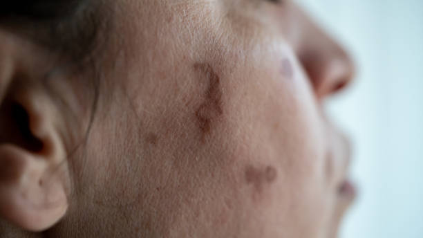 Birthmark Removal in Dubai: 2026 Guide to Tech & Results