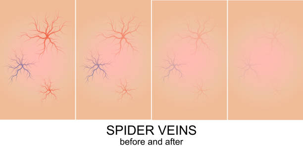 Spider Veins Treatment in Dubai: What to Expect Before and After