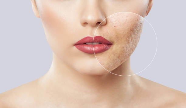 Large Pores Treatment in Dubai: Oily Skin Solutions