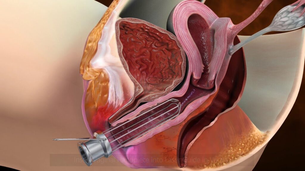 Top 10 Benefits of Laser Vaginal Tightening for Women in Dubai