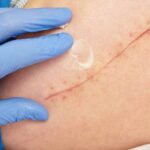 Laser Scar Removal Dubai | How It Works & What to Expect