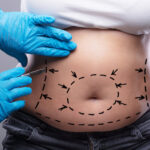 Achieving Your Ideal Body Shape with Liposuction Surgery in Dubai