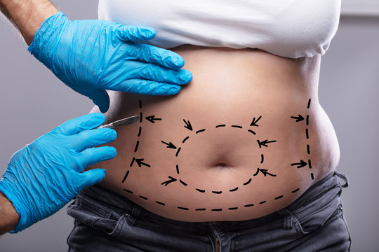 Achieving Your Ideal Body Shape with Liposuction Surgery in Dubai