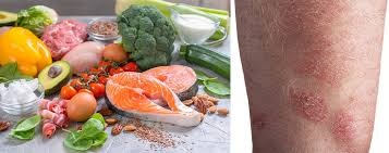 How Diet and Nutrition Influence Skin Disorders