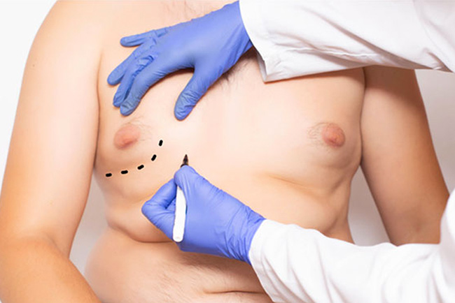 Gynecomastia Surgery Cost: Choosing the Right Procedure