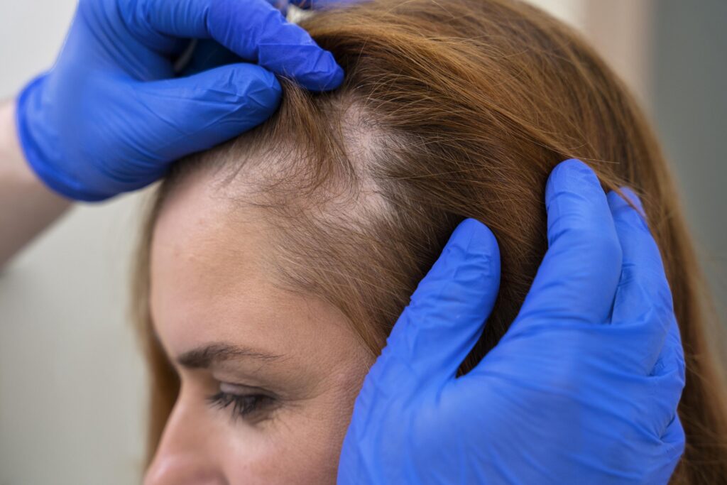 Best Hair Treatment in Mumbai for Hair Loss, Hair Fall, and Baldness