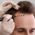 Hair Transplant in Dubai: Restore Confidence with Advanced Techniques