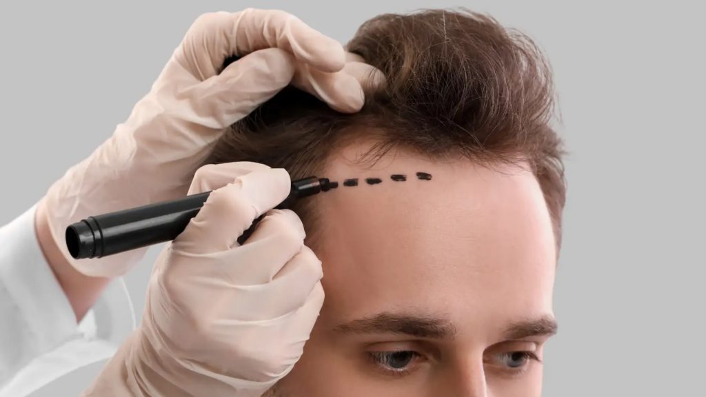 Hair Transplant in Dubai: Restore Confidence with Advanced Techniques