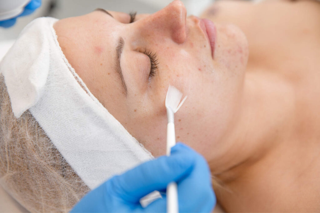 Everything You Need to Know About Chemical Peels in Dubai