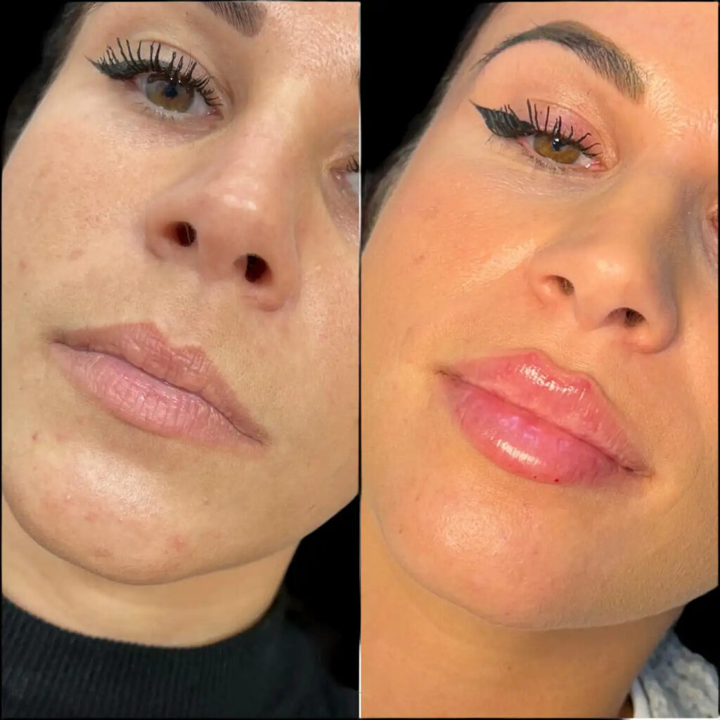 Dermal Fillers in Dubai Modern Non-Invasive Beauty Solution